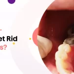 how-to-get-rid-of-cavities