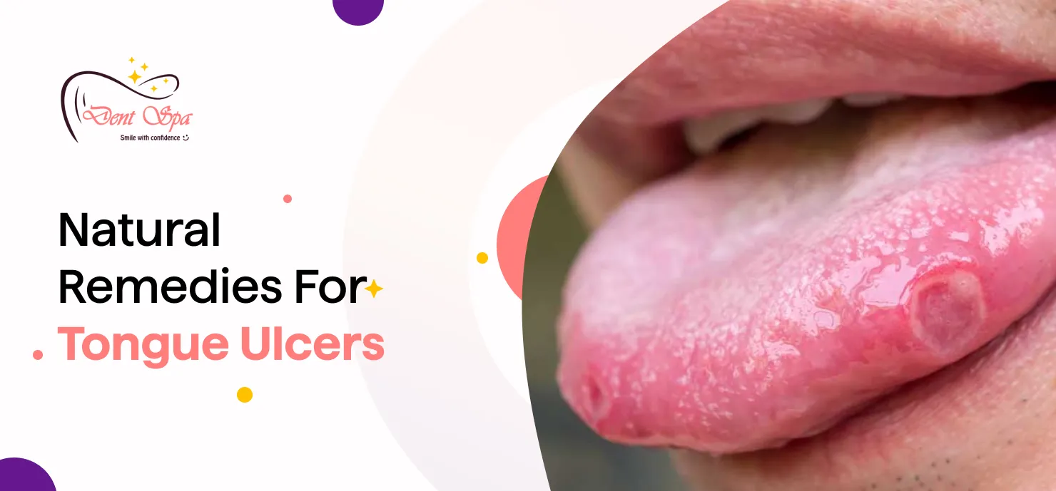 Natural remedies for tongue ulcers