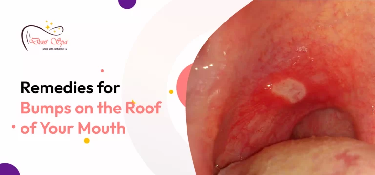 Bumps on the Roof of Your Mouth