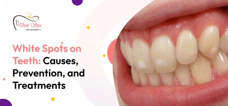 white spots on teeth