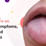 canker sore on tongue